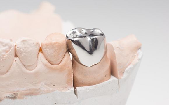 Fabrication de couronnes dentaires métalliques