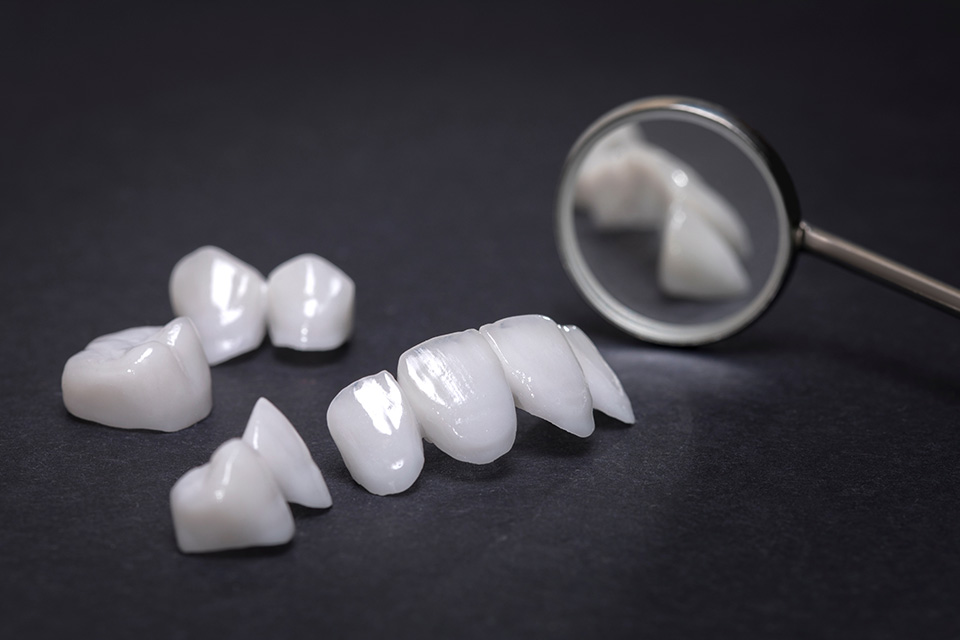 Prothèses dentaires en céramique